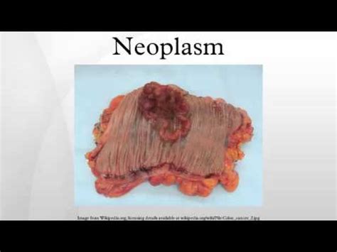 neoplastom